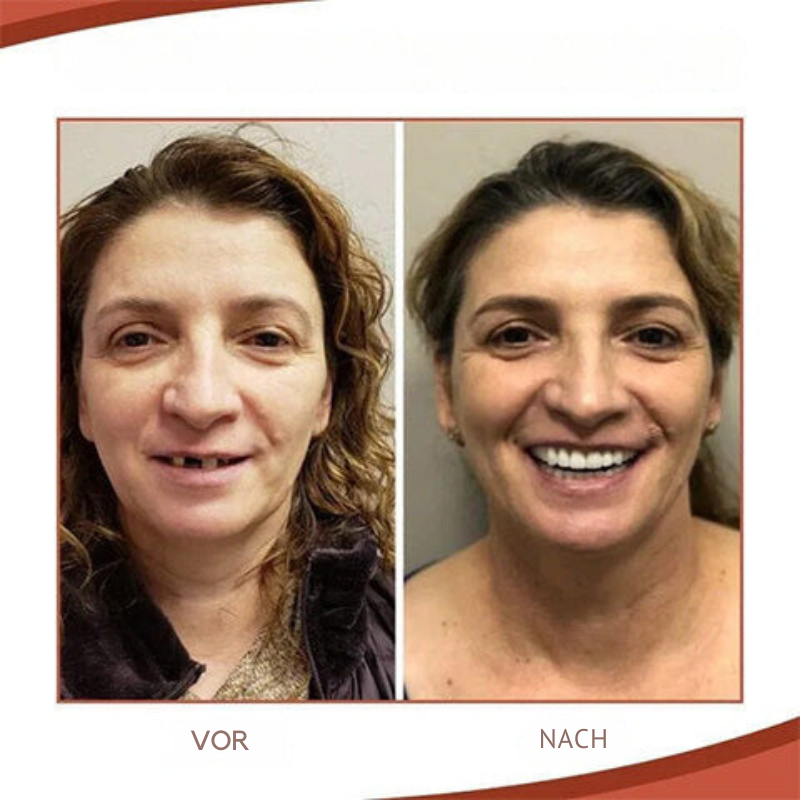 שיניים תותבות בהתאמה אישית של Dentecare — התאמה אישית וחיוך טבעי ובטוח
