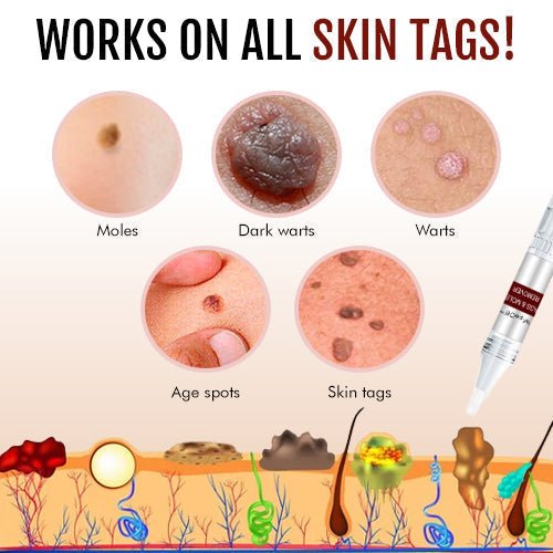 Herbal Wart Remover Precision Pen for Skin Blemishes