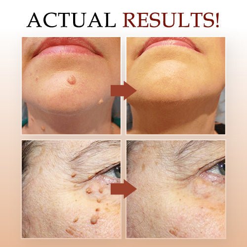 Herbal Wart Remover Precision Pen for Skin Blemishes