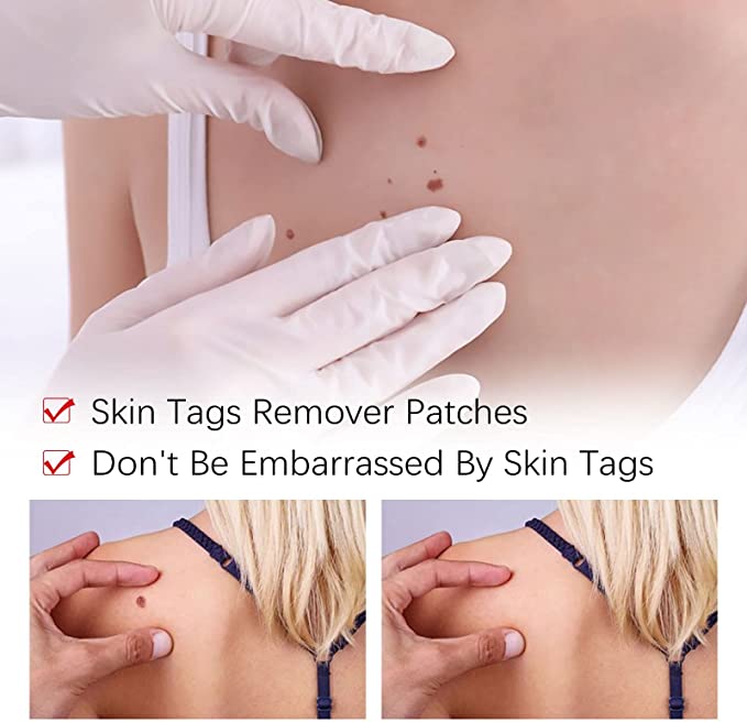 Herbal Wart Remover Precision Pen for Skin Blemishes