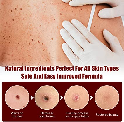 Herbal Wart Remover Precision Pen for Skin Blemishes