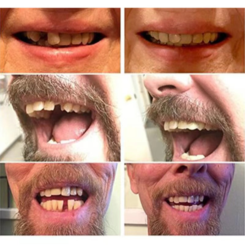 High-Quality False Teeth | ventumra