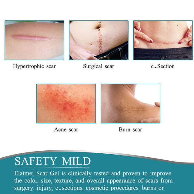 Silicone Scar Tape Roll for Appearance Management | ventumra