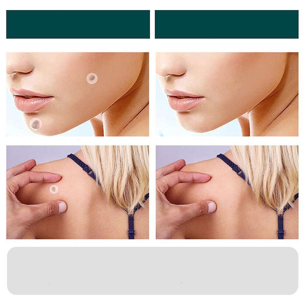 Hydrocolloid Patches for Minor Skin Imperfections - 120 Count | ventumra